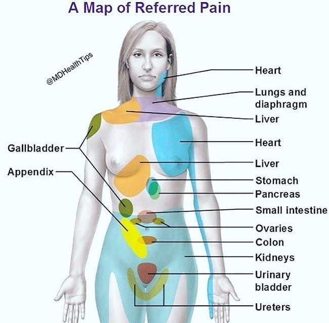 referred pain map
